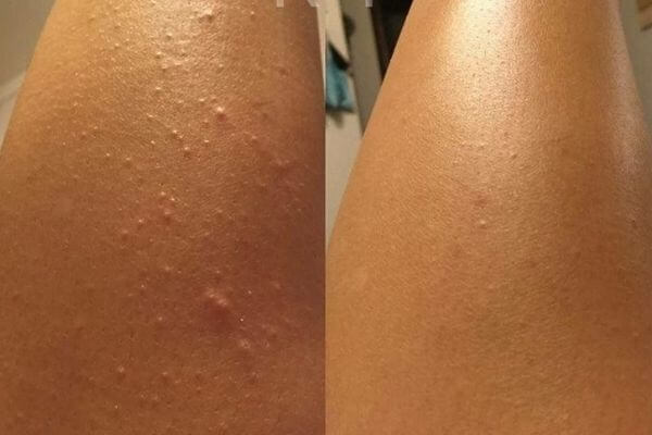 Queratose pilar nas pernas